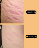 کرم رفع ترک های پوستی یا استرچ مارک گاتیو
