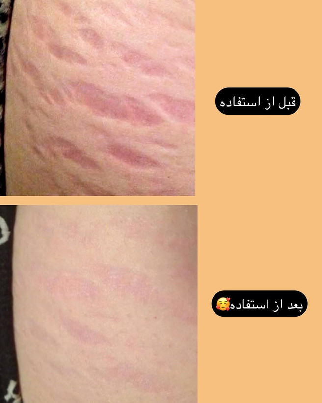 کرم رفع ترک های پوستی یا استرچ مارک گاتیو